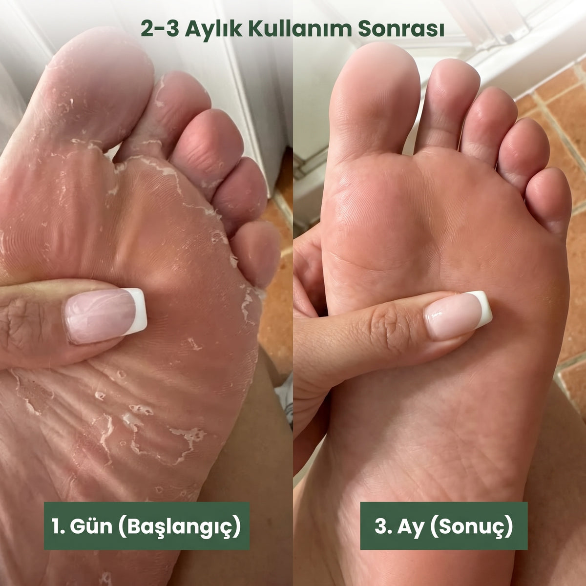 Almirana | Mantar-Pişik-Tahriş Karşıtı Çay Ağacı Bakım Kremi
