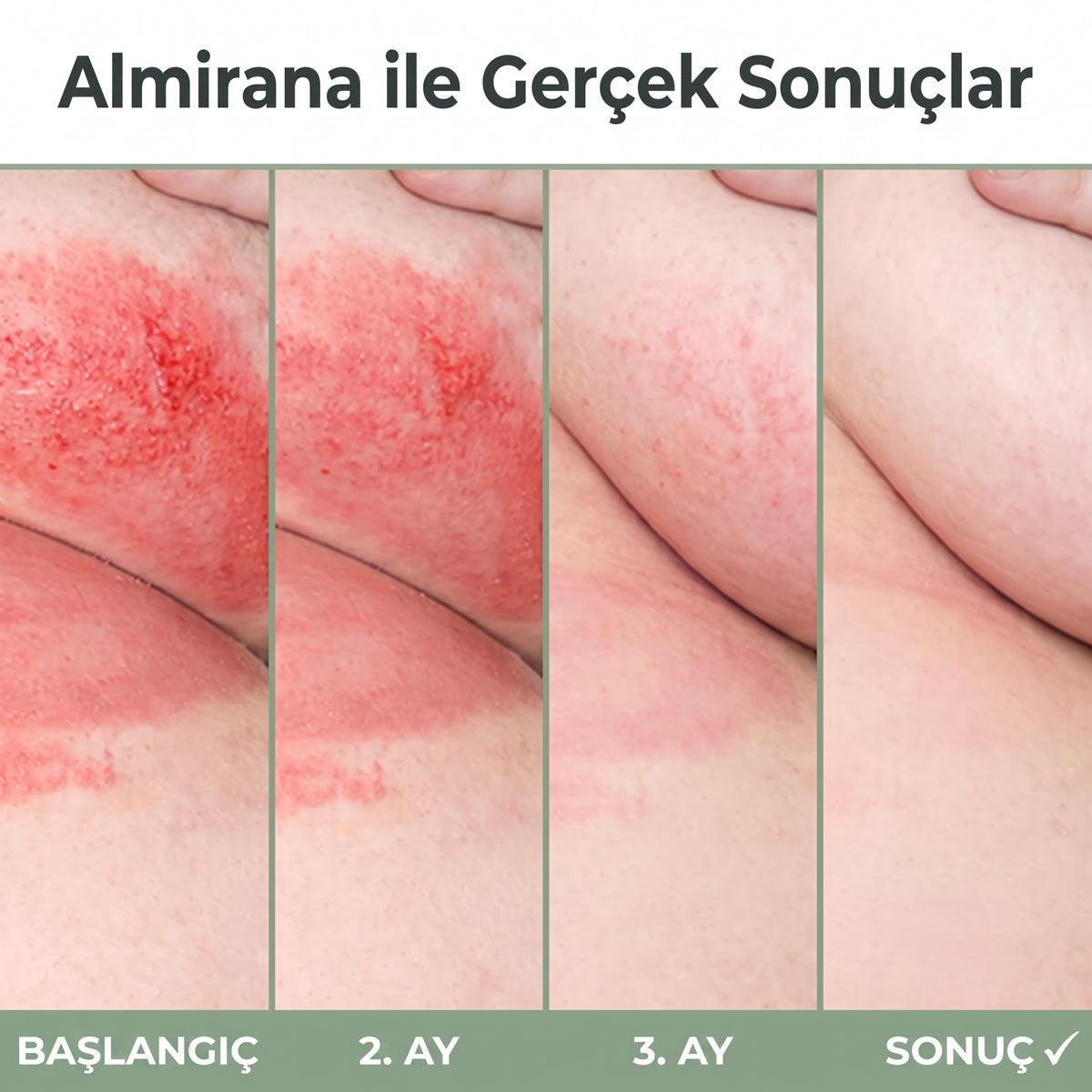 Almirana | Mantar-Pişik-Tahriş Karşıtı Çay Ağacı Bakım Kremi