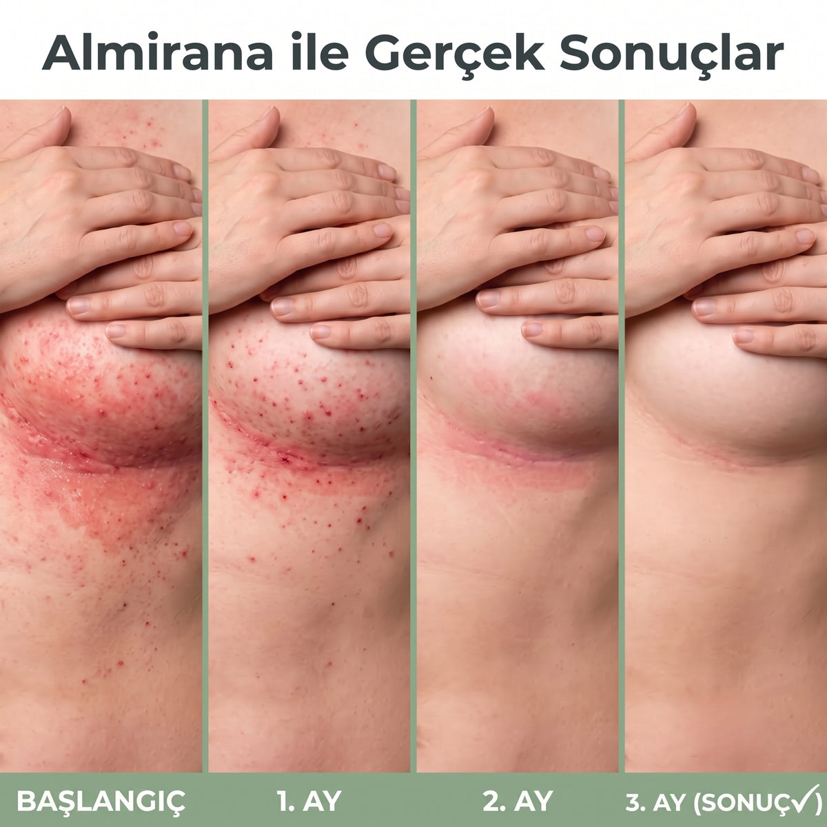 Almirana | Mantar-Pişik-Tahriş Karşıtı Çay Ağacı Bakım Kremi